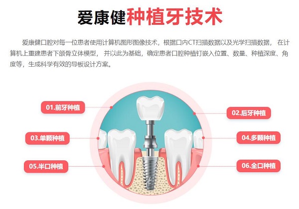 深圳種植牙