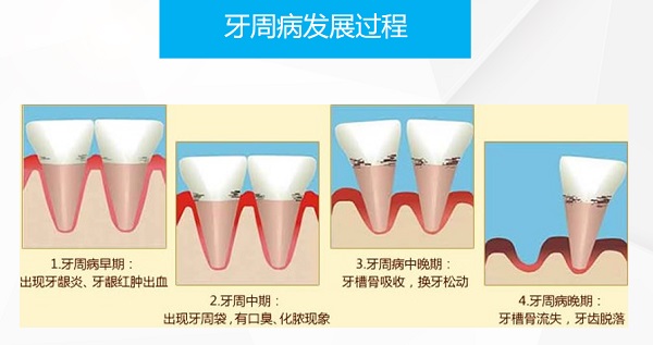 如何預防牙周疾病