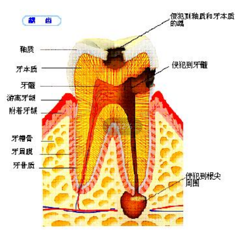 深圳根管治療多少錢