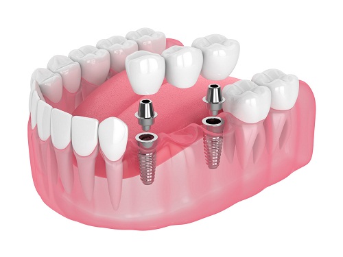 牙齒缺失的較佳修復方法