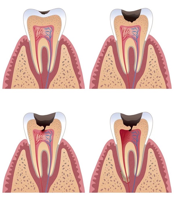 導致牙齒敏感的原因有哪些