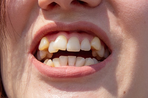 矯正牙齒一定要拔牙嗎？正畸拔牙一般都是拔哪些牙