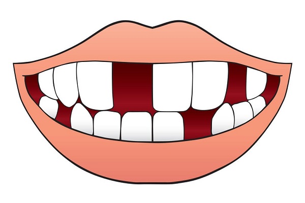 牙齒缺失會有什麼影響危害?愛康健口腔醫院植牙幾多錢一雙?