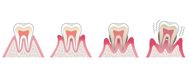 為什麼牙周病容易被人忽視?如何預防牙周病?