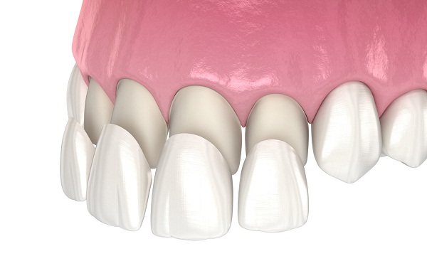 瓷貼面牙齒有危害嗎?瓷貼面牙齒壽命多長?