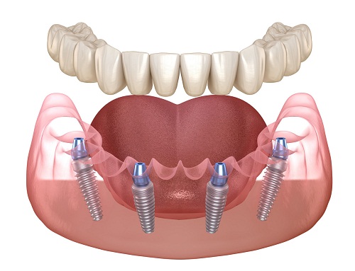 半口/全口牙缺失如何修復?all-on-4和all-on-6種植牙手術哪個好