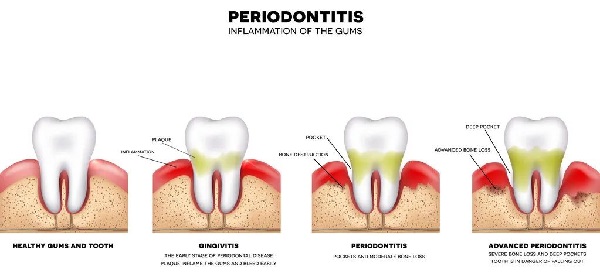 牙結石是引起口臭及牙周疾病的元兇
