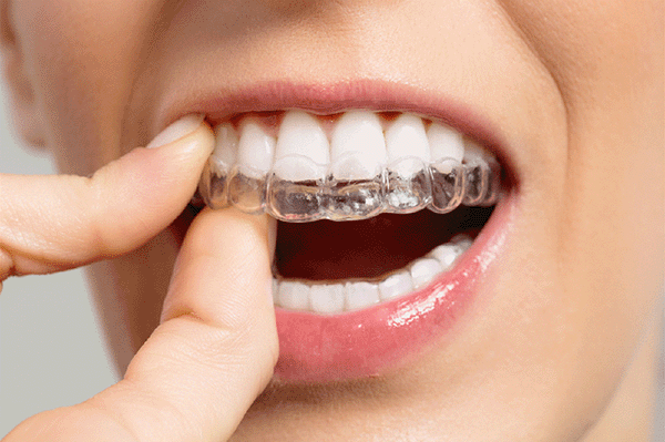 深圳愛康健齒科牙醫解析牙根短會不會影響做矯齒箍牙?