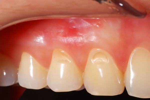 想問牙齒為什麼會出現楔狀缺損?牙齒有楔狀缺損需要補牙嗎