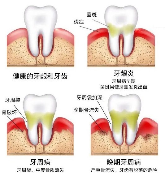 是什麼原因導致牙周炎的發生?牙周炎該怎麼治