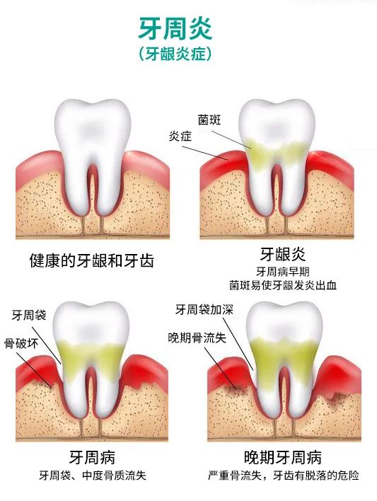 請問牙結石對牙齒什麼危害?洗牙會把牙齒洗壞