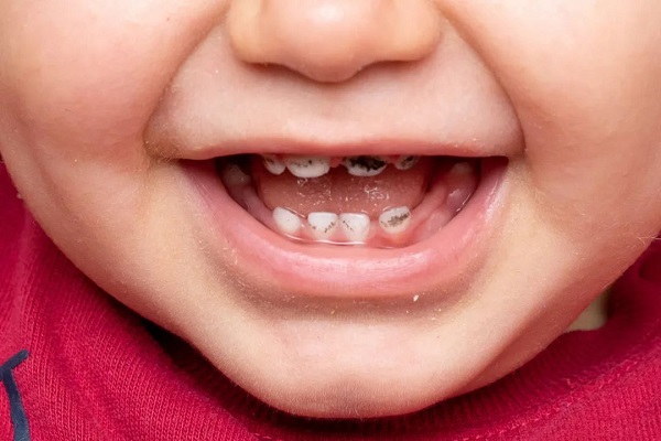 想問下孩子牙齒發黑是怎麼回事？是不是蛀牙？