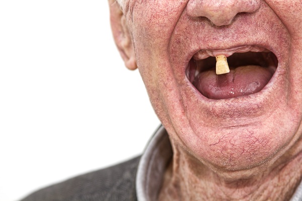 解析全口牙缺失對於缺牙者身體健康有什麼危害？