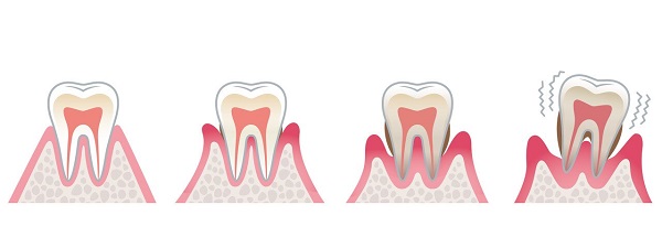 牙周炎怎麼辦