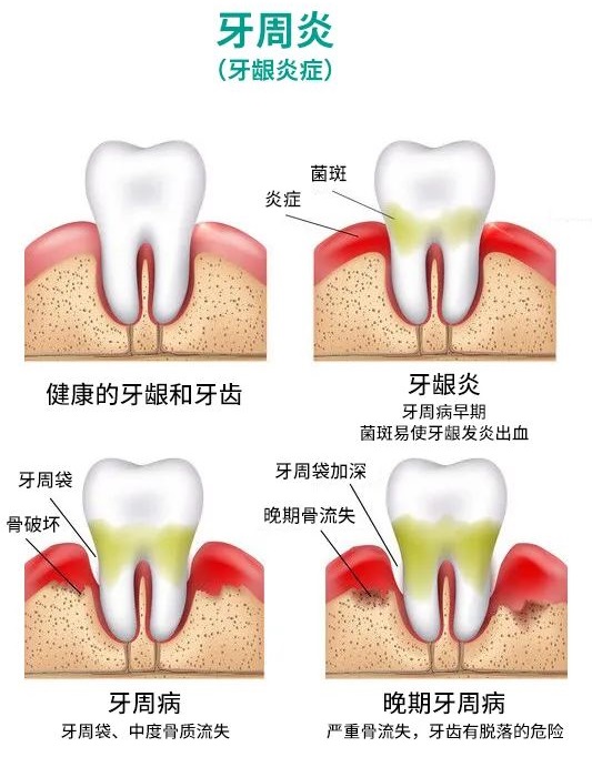 得了牙周病该怎么办