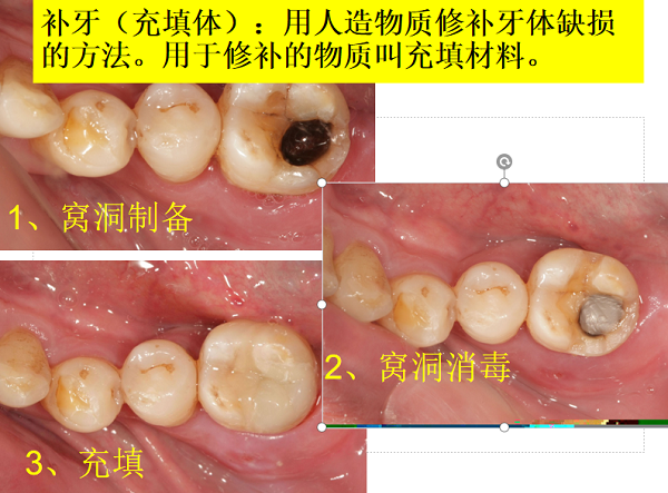 深圳補牙多少錢